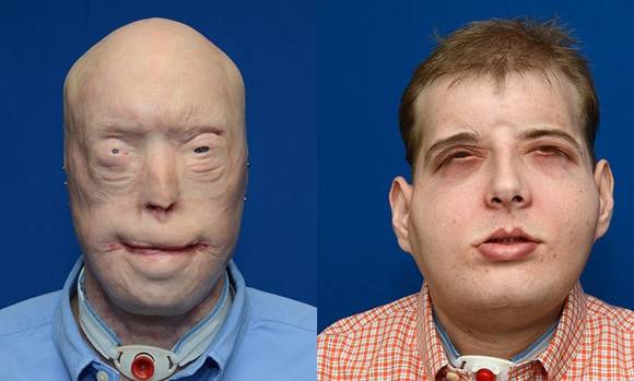 Antes y después del trasplante